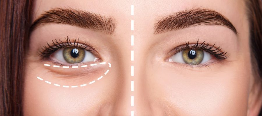 GÖZALTI-IŞIK-DOLGUSU