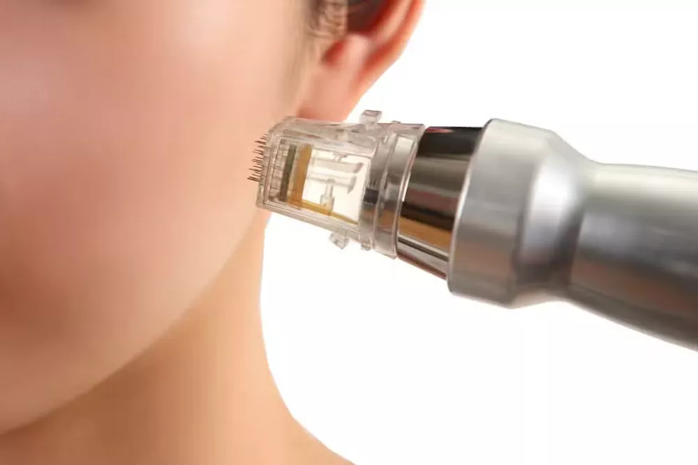 Altın İğne 1 altın iğne cihazı