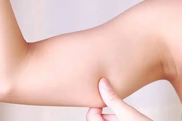 ameliyatsız-kol-germe