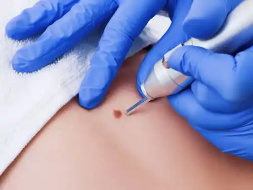 Ben Aldırma 1 lazerle ben aldırma