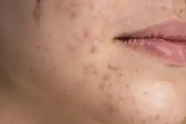 Sivilce İzi Tedavisi