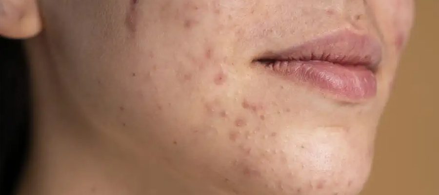 sivilce-izi-tedavisi