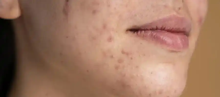 Sivilce İzi Tedavisi