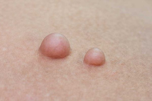 yağ-bezesi-aldırma