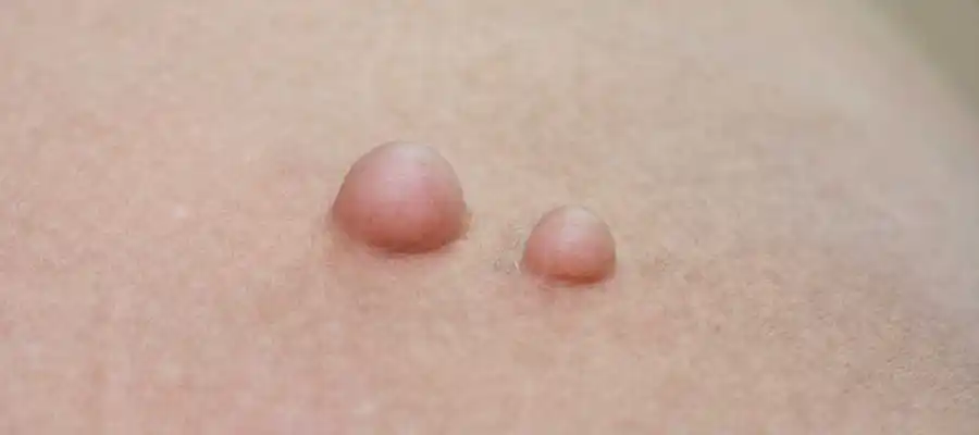 yağ bezesi aldırma