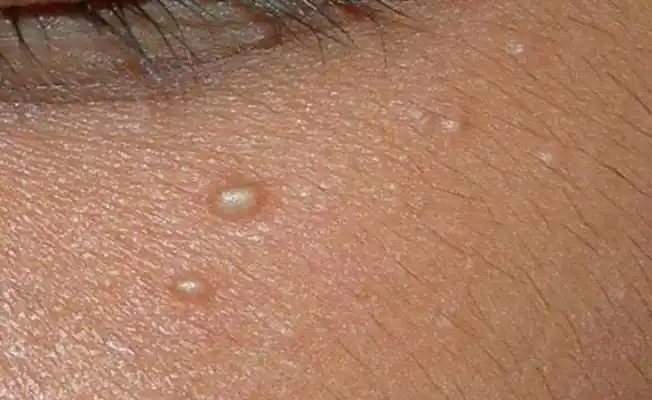 Yağ Bezesi Aldırma 1 Yağ bezesi