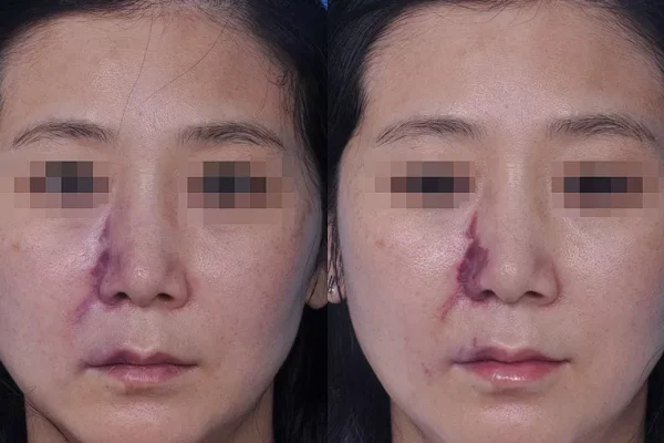 burun-dolgusu-tehlikeli-mi