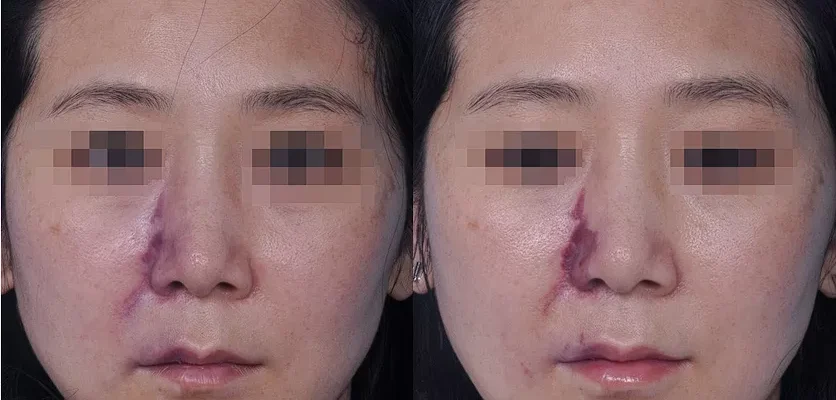 burun-dolgusu-tehlikeli-mi